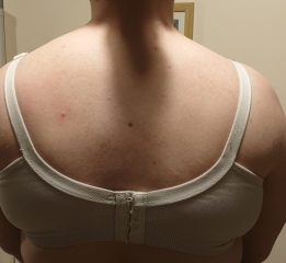 Abnormal shoulders