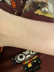 Strange rash on feet