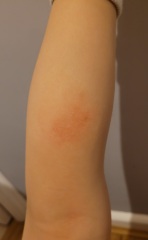 Is this eczema?