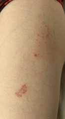 What on earth is this rash? Should I keep off school?