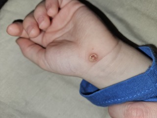 Is this a wart?