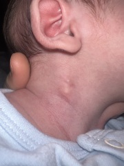 Lumps on babies neck