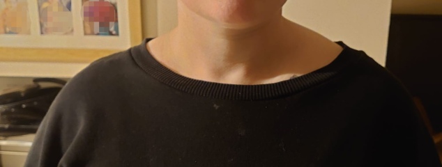 Abnormal shoulders