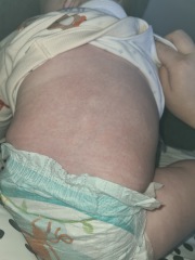 Rash on 10 month old