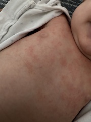 Heat rash or eczema? Or something else?