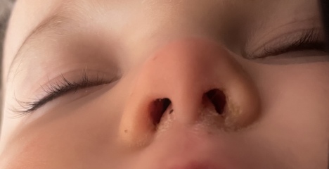 17 month olds nose, really worried