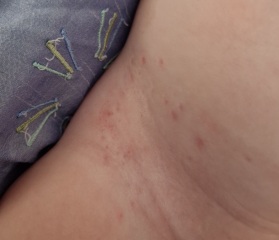 Does anyone know what this rash is?
