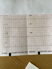 Borderline ECG - long qt interval
