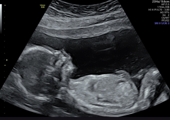 17 week private ultrasound