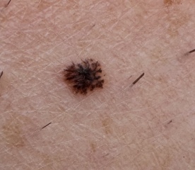 Does this look like melanoma