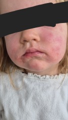 Scarlet Fever?