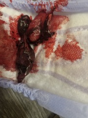 Failed Abortion- Continued pregnancy after finding out..