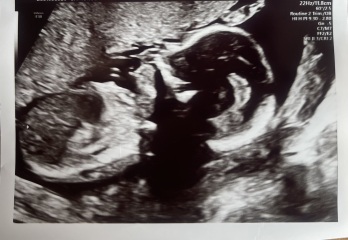 Nub theory guesses - boy or girl ❤️❤️