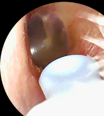 Unwell for a year with dizziness, tinnitus and balance issues, does my ear drum look ok?