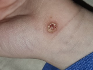 Is this a wart?