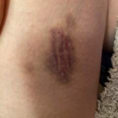 Unexplained bruising - blood test all clear