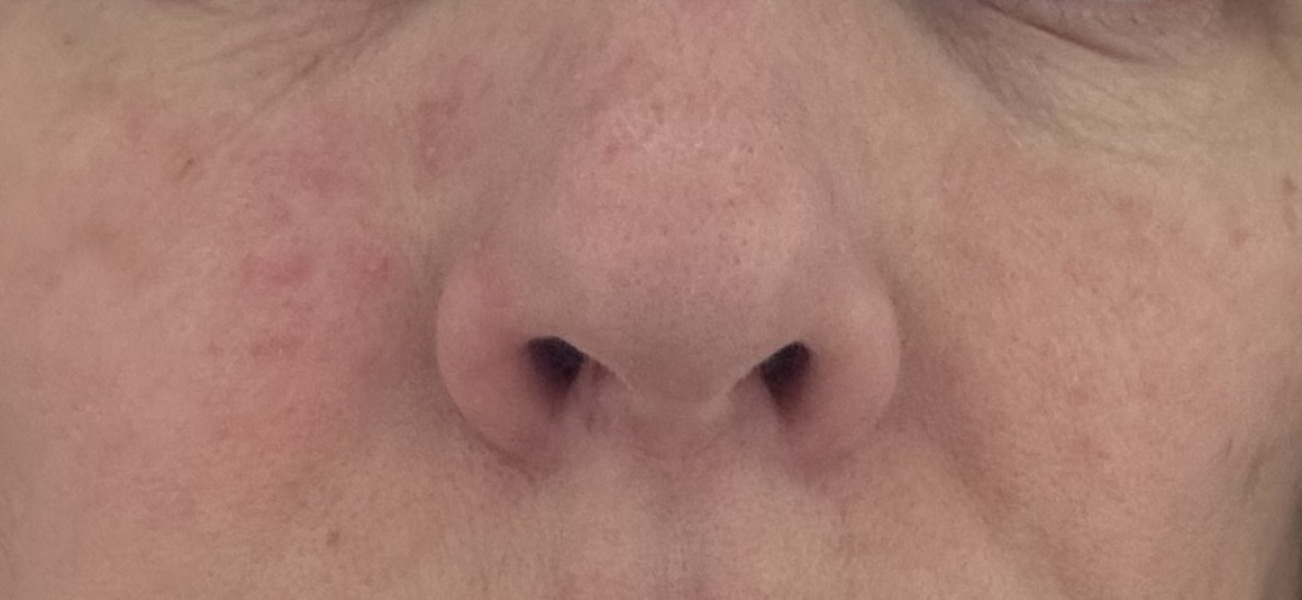 Blemish rash/spots on face