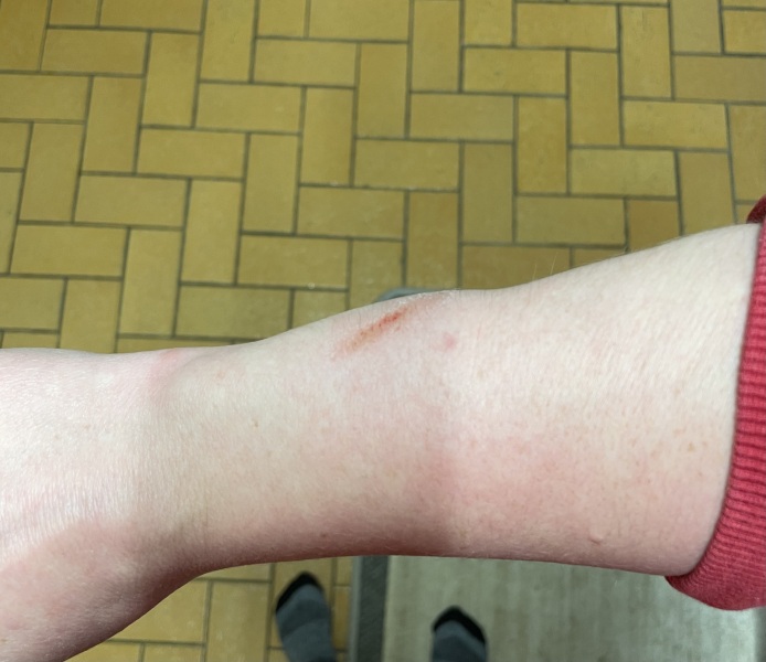 Bruise or break?