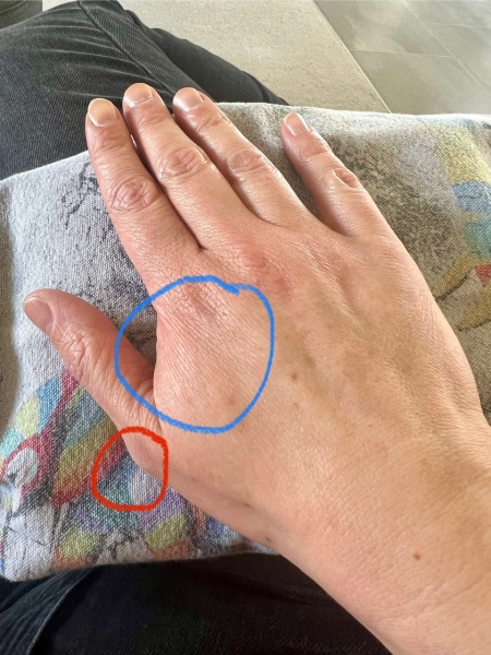 Swelling between thumb and index finger