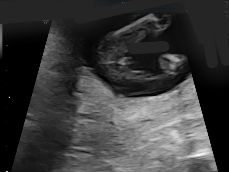 Gender scan at 15 weeks and 3 days