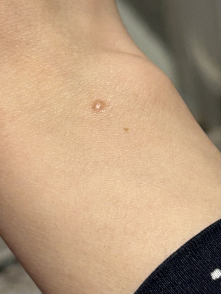 Mole Concerning?