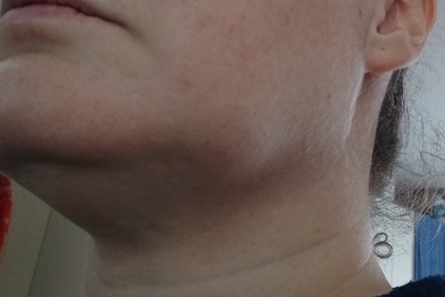 Soft lump on jawline