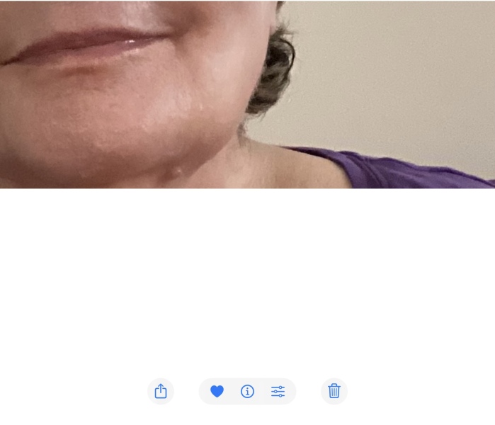 Had filler yesterday...