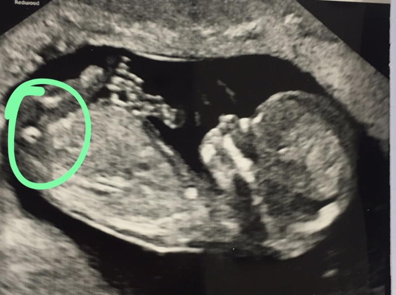 Anyone know what this is on my ultrasound?