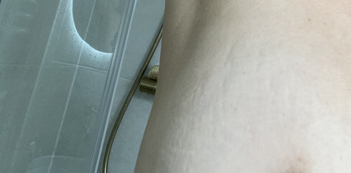 Breast marks