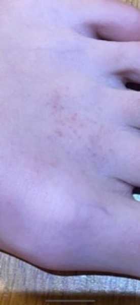 To present to ED with 13yr old rash.