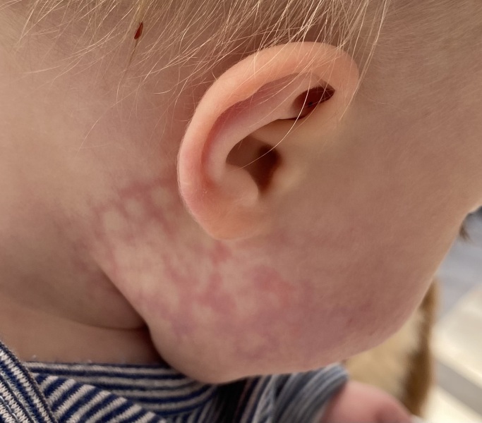 Cutis marmorata on baby’s face 