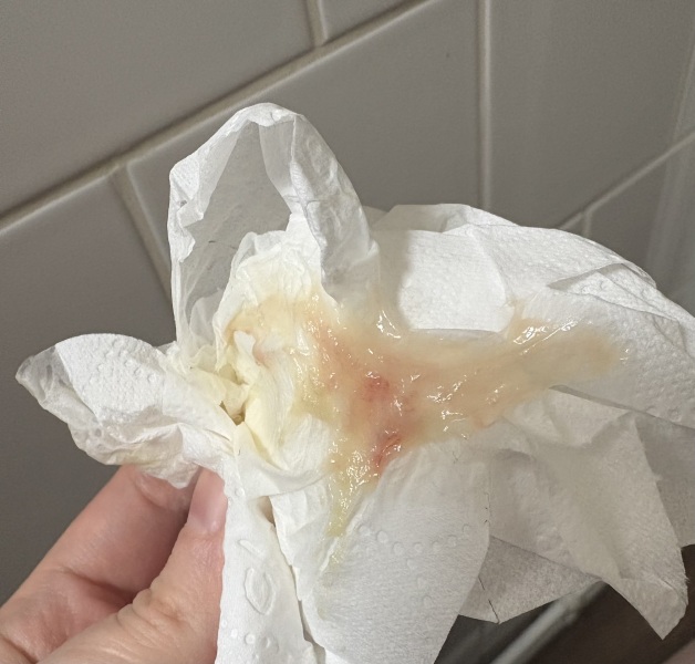 (TW discharge pic) Ovulation or implantation bleeding?