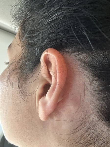 Lump behind ear