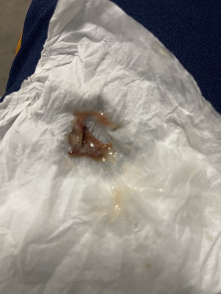 Can you blow a nasal polyp out? 