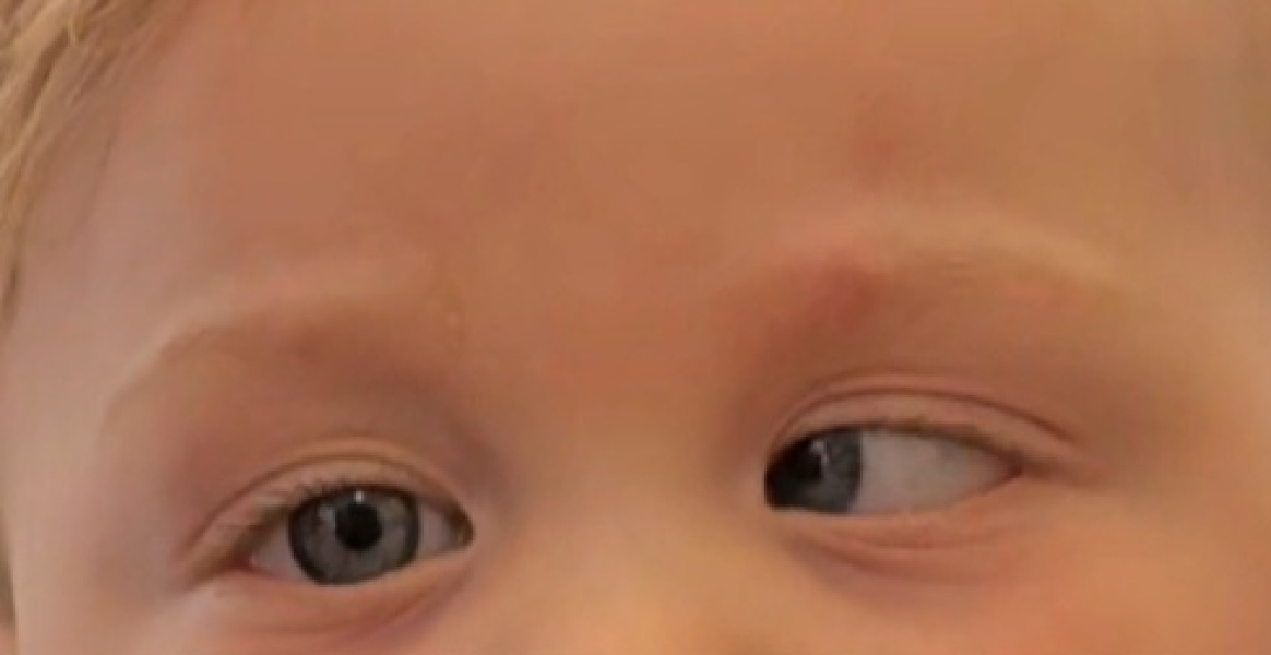 16 month old - eye turning inwards