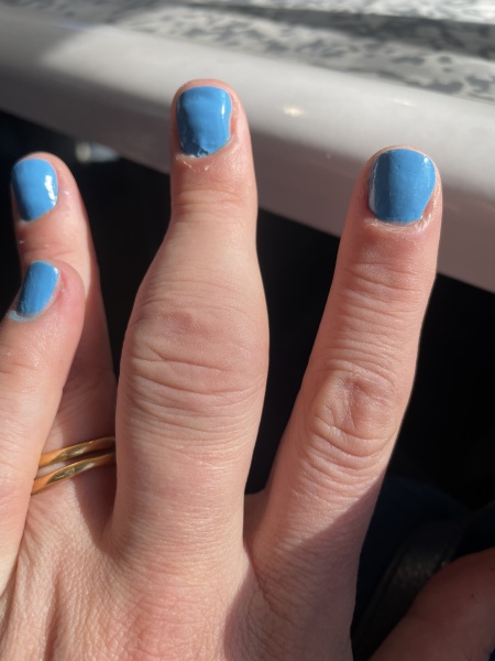 Dactylitis- psoriatic arthritis sausage fingers