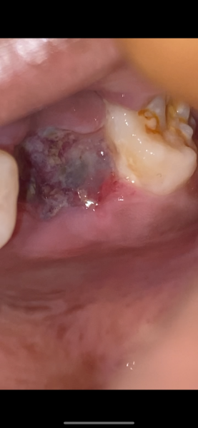 Tooth extraction