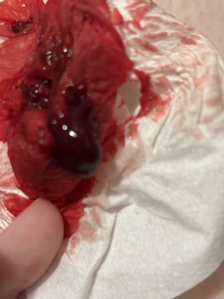 WARNING Graphic photo - my periods are just clots