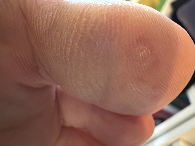 What is hurting on my toe? Is it a chilblain? A verruca? Something else?