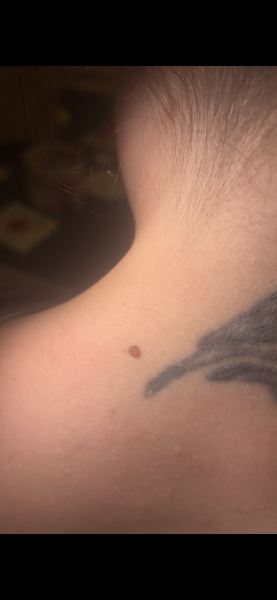 Mole worry