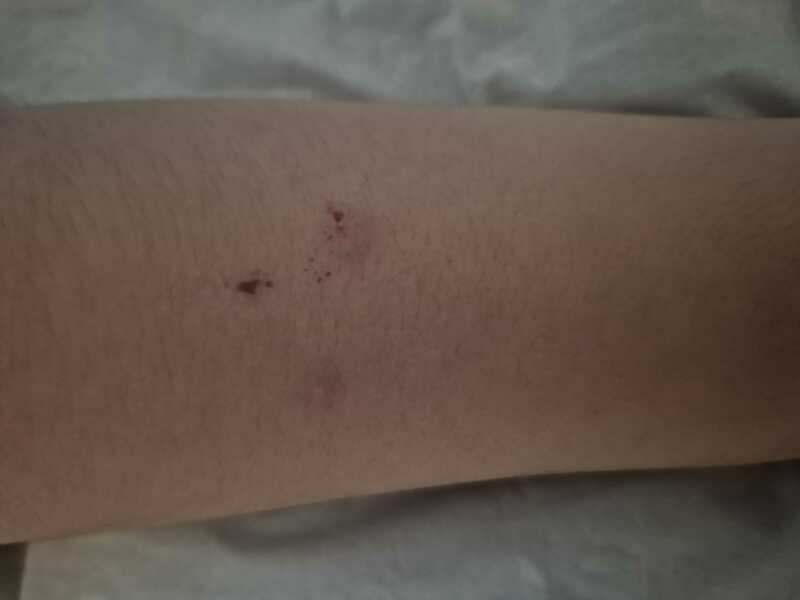 What are these spots / bites?