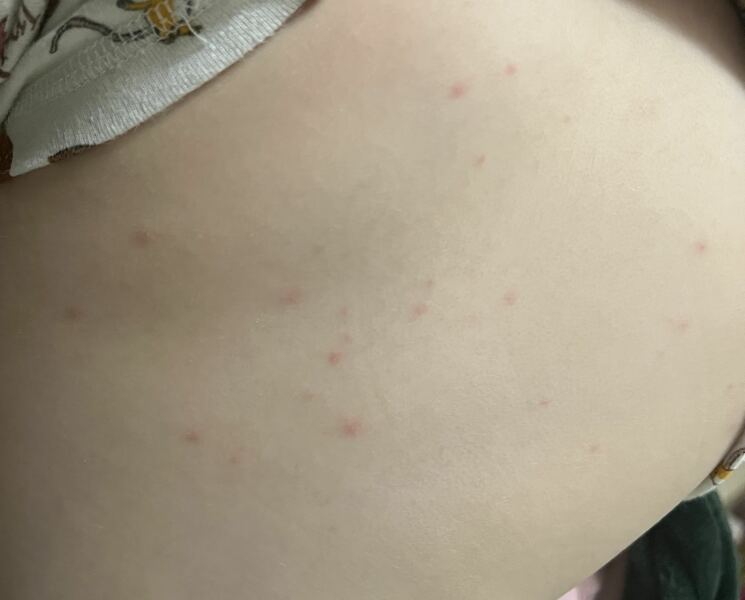 Chickenpox?