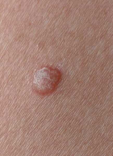Spot on skin getting bigger. Pic - what could it be?