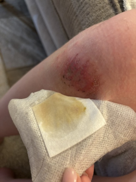 Wound advice