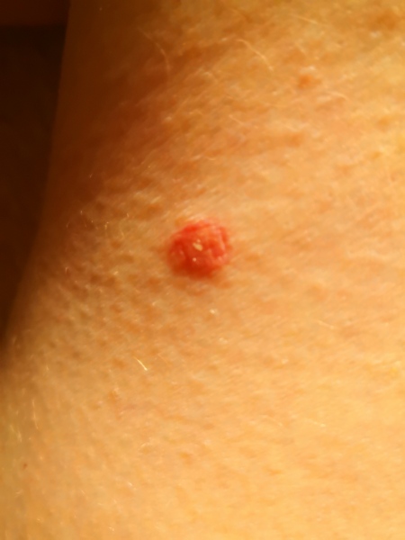 To think these look like cigarette burns? Photo attached
