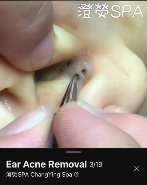 Ear blackhead