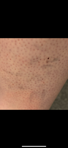 To be worried about these new marks on my calf? Photo