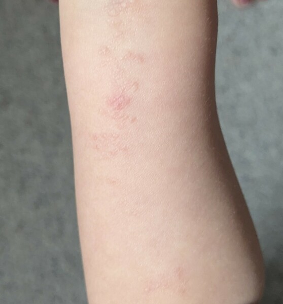 Rash on 1yo arm