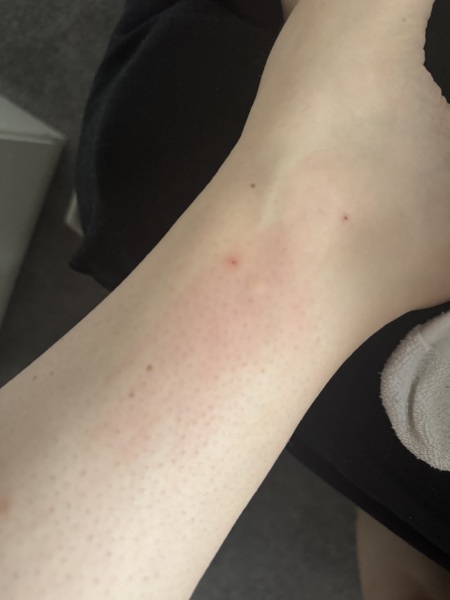 Bed bugs or fleas