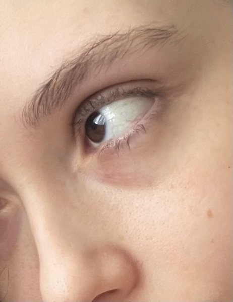 What can I do? Really bad dark circles.